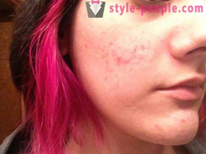 Kāpēc nevar izspiest pimples uz jūsu sejas?