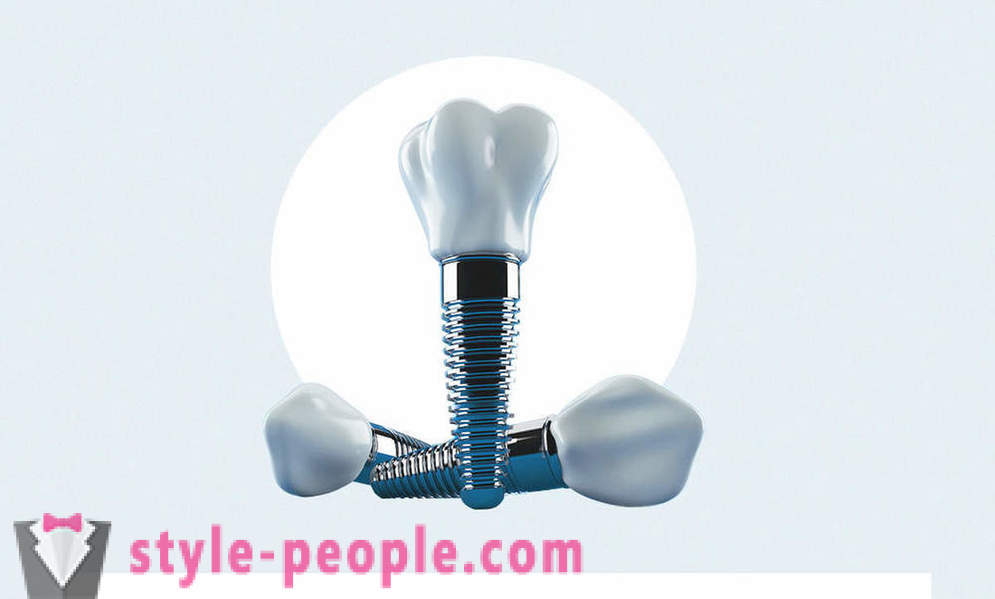 8 jautājumi par zobu implanti