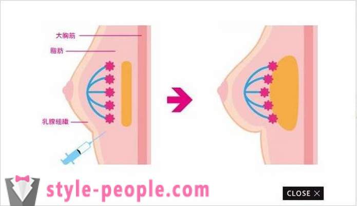 Japānā, viņi sāka palielināt krūtis uz vienu dienu