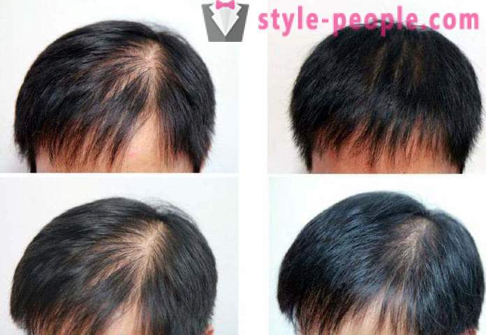 Spray matu augšanu: pārskatu par labākajiem un atsauksmes. Aktivētājs matu augšanu