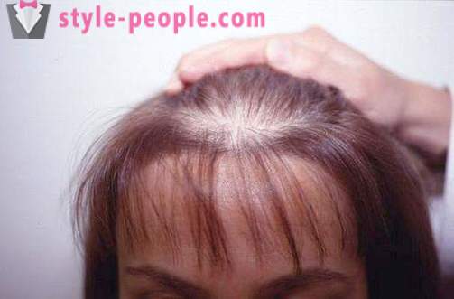 Darsonval matiem. Pieteikums darsonvalya ārstēšanai un profilaksei matu izkrišana