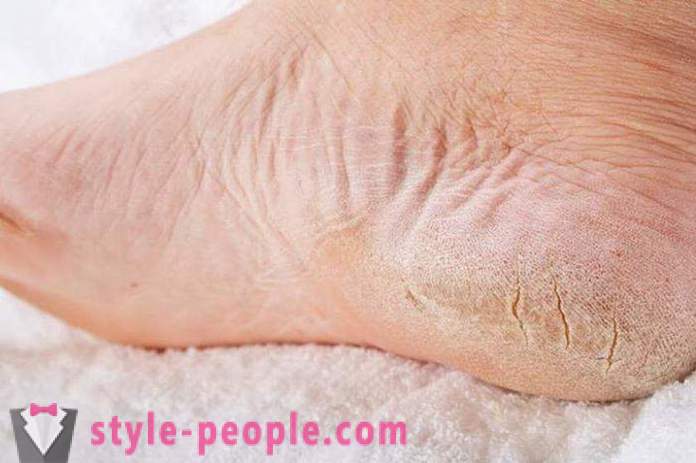 Sausa āda uz jūsu kājām: cēloņi