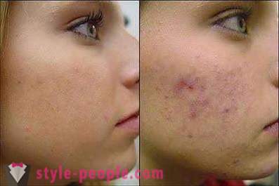 Vēlaties uzzināt, kā noņemt pēdas pimples uz sejas?