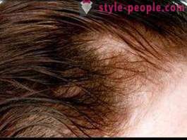 Kāpēc mati izkrist pēc dzemdībām? Ko darīt, lai saglabātu matus bieza?